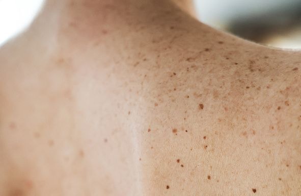 Une piste encourageante pour un vaccin contre le cancer de la peau