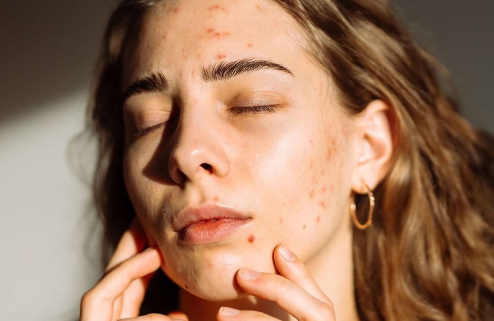 Acné, psoriasis, eczéma… quand les problèmes de peau  fragilisent notre santé mentale et favorise la dépression