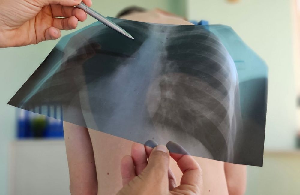 Tuberculose infantile : l’OMS alerte sur une hausse inquiétante en Europe