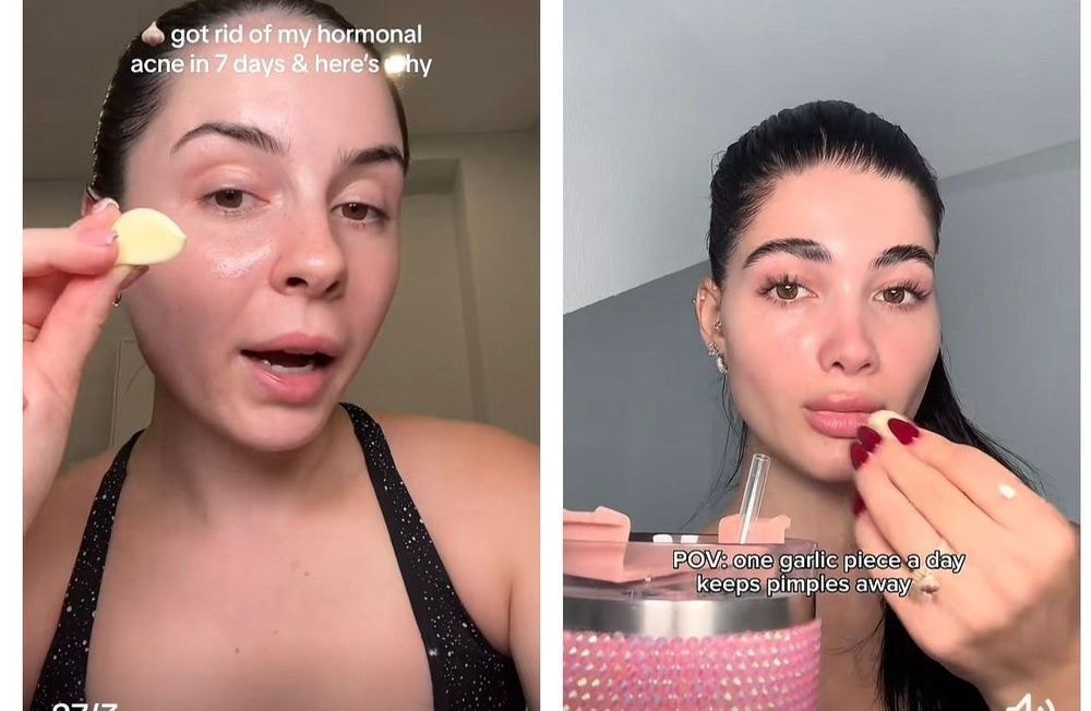Acné : l’ail cru, le nouveau remède naturel anti-bouton ?