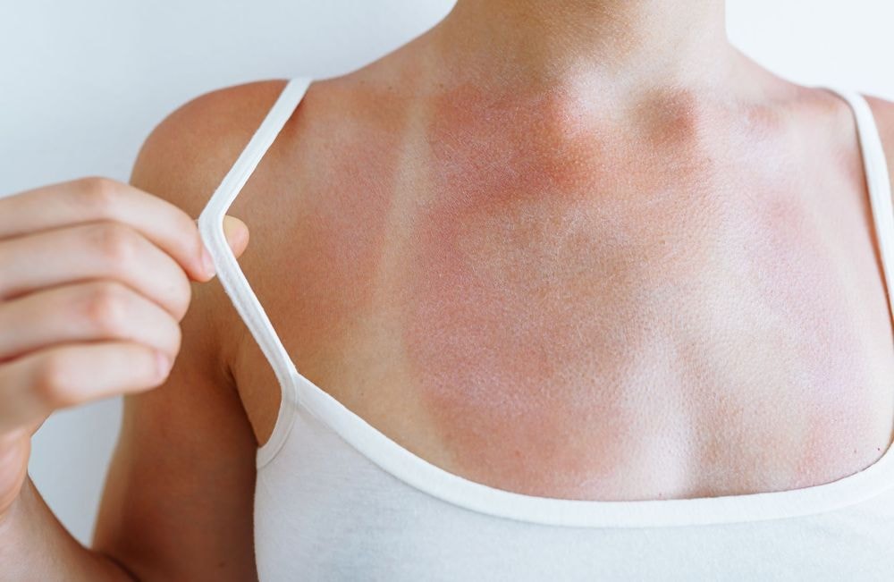 Yaourt, miel, melon... 6 remèdes naturels (et surprenants) pour soulager les coups de soleil