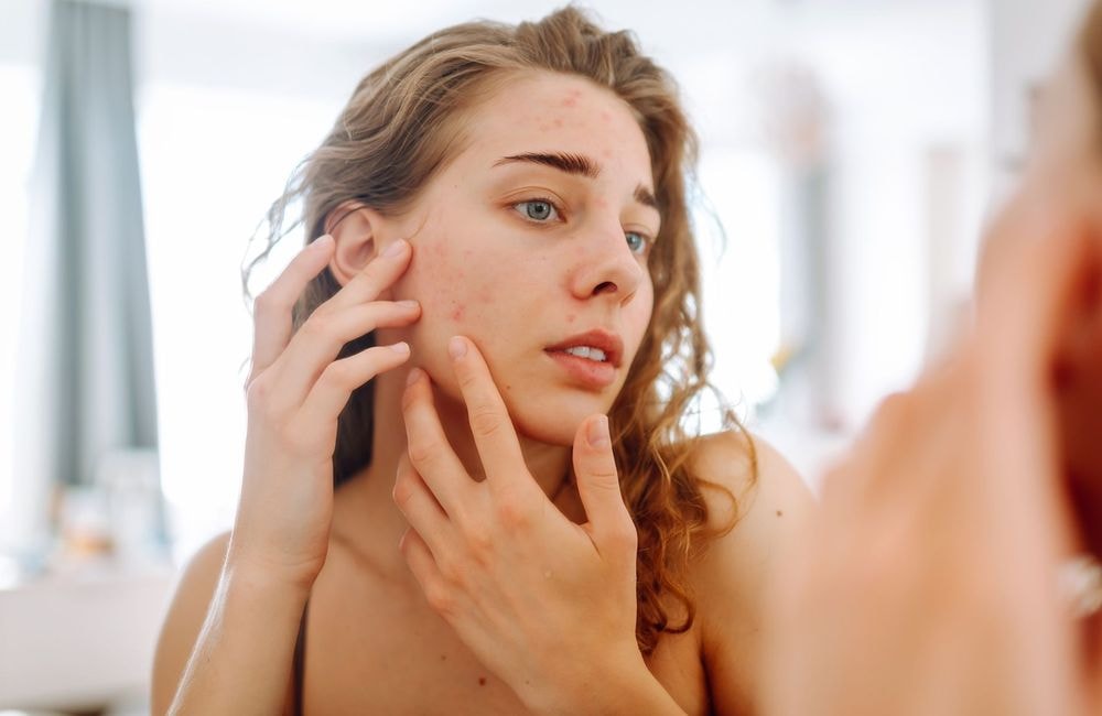 Vous avez une poussée de boutons inattendue ? Votre barrière cutanée est peut-être abîmée