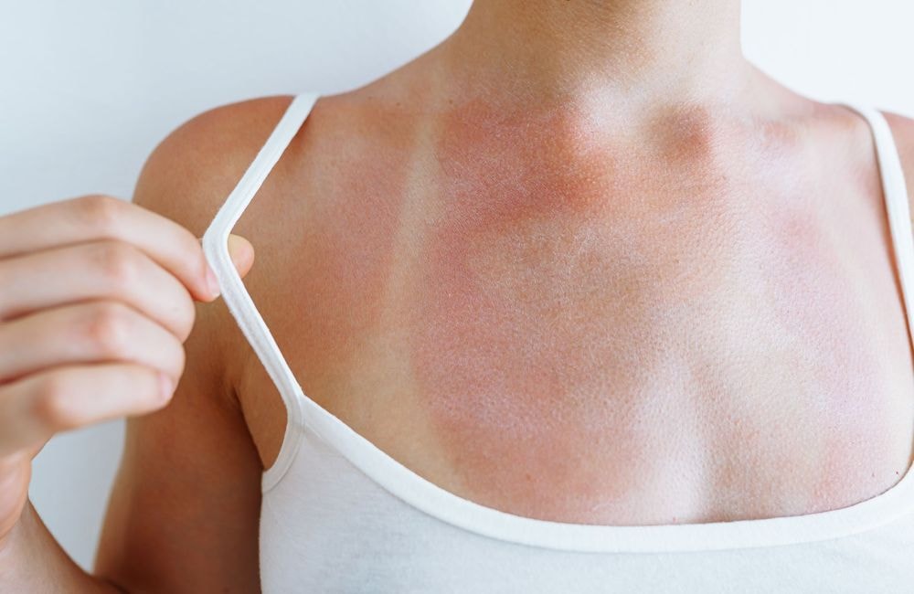 Après la tendance “anti-crème solaire”, la trend “Burn lines” est celle qui inquiète vivement les dermatologues