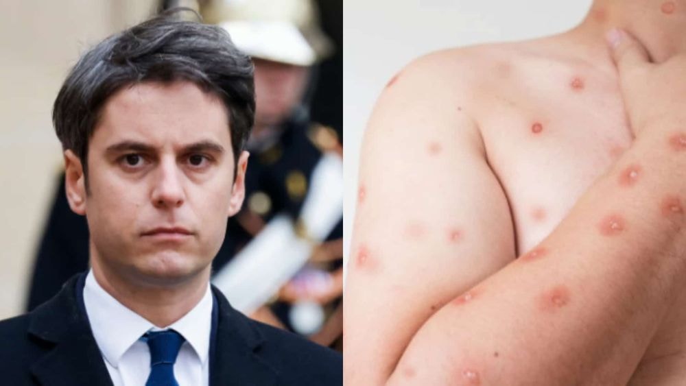 Variole du singe : l'OMS s'inquiète, Gabriel Attal annonce d'importantes mesures !