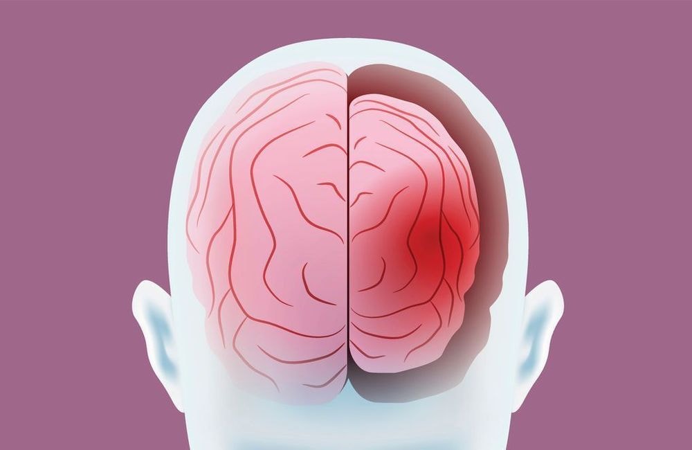 Maladie de Huntington : comprendre cette pathologie encore incurable