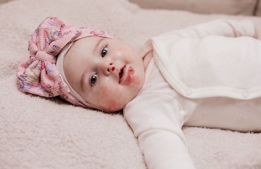 Qu’est-ce que l'épidermolyse bulleuse jonctionnelle, cette maladie rare qui touche les bébés ?