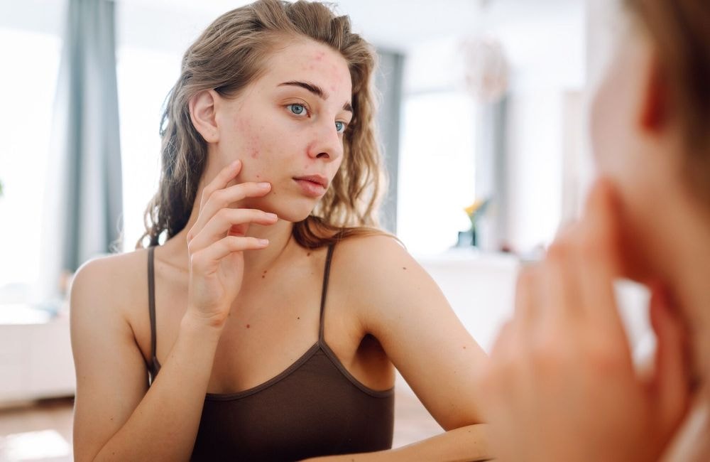 Acné adulte : les 3 actifs à adopter dès le matin pour une peau plus nette