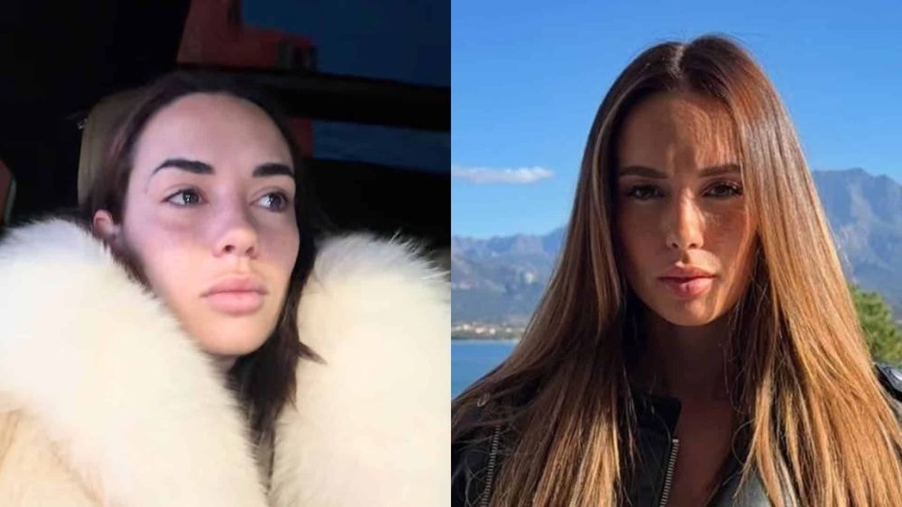 "Un cancer" : Hilona en larmes, elle annonce une terrible nouvelle !