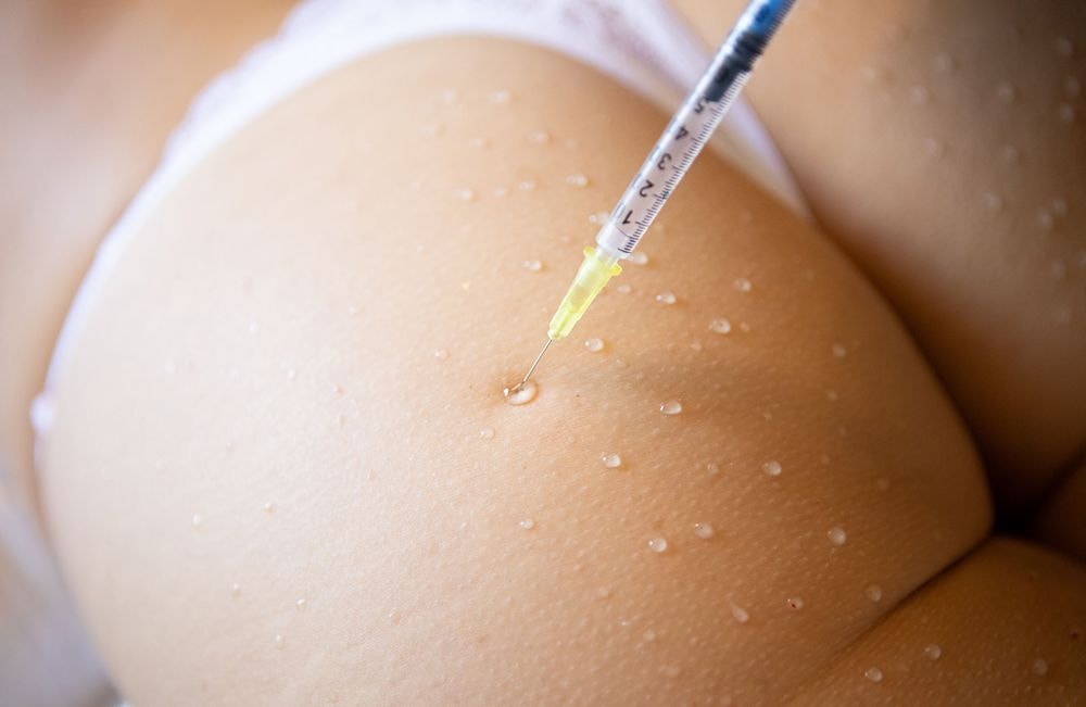 Qu’est-ce que le « BBL Filler », cette technique d'injections dans les fesses qui inquiètent les médecins ?