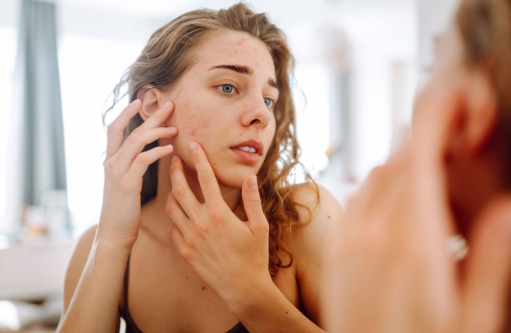 Acné : voici pourquoi vous avez plus de boutons à l’automne