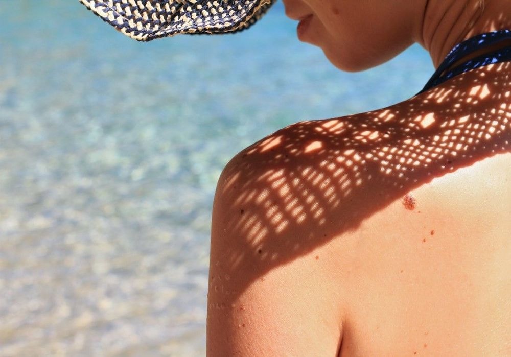 Comment surveiller un grain de beauté ?